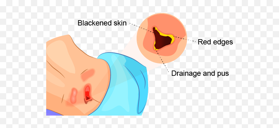 Stage 4 Bedsores - Nursing Home Neglect U0026 Severe Bedsores Emoji,Infectious Emotion