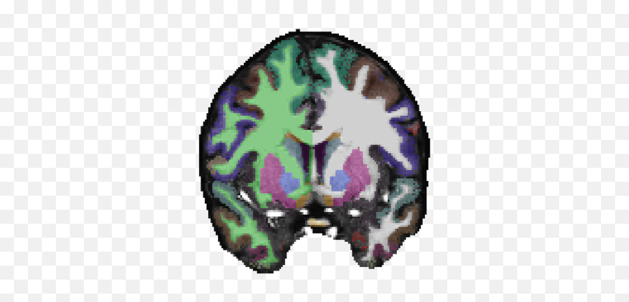 Analyzing Brain Structure In - Schizophrenia Brain Structure Emoji,Schizophrenia & Emotions