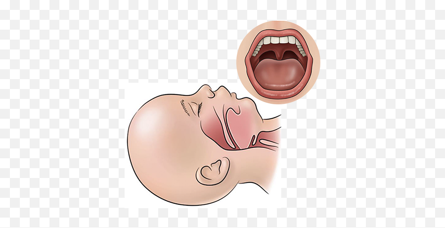 Pediatirc Tracheostomy Handbook Patient And Family - Ugly Emoji,Basic Emotions Baby Faces