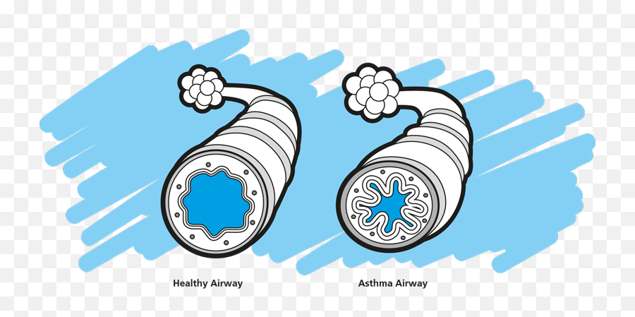 Lungs Clipart Airway Lungs Airway Transparent Free For - Asthma Clipart Emoji,Wheeze Emoji
