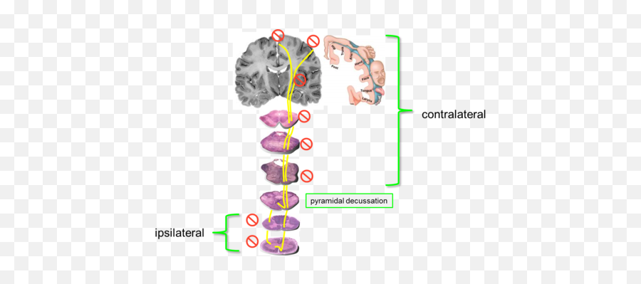 Tc5 Neuro Lesions Flashcards Quizlet Emoji,Papez Circuit Emotion