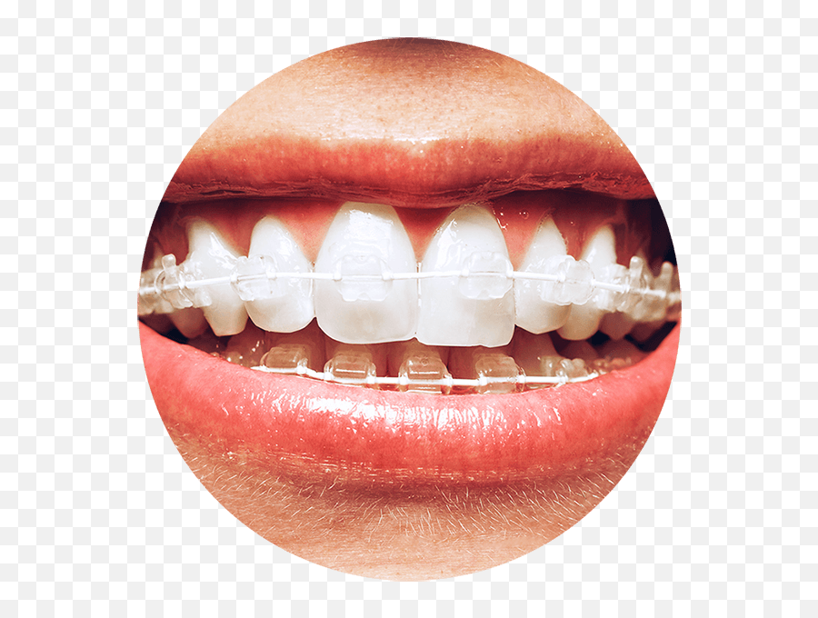 Smile Smile Png Transparent - Six Month Smiles Emoji,Braces Smile Emoji