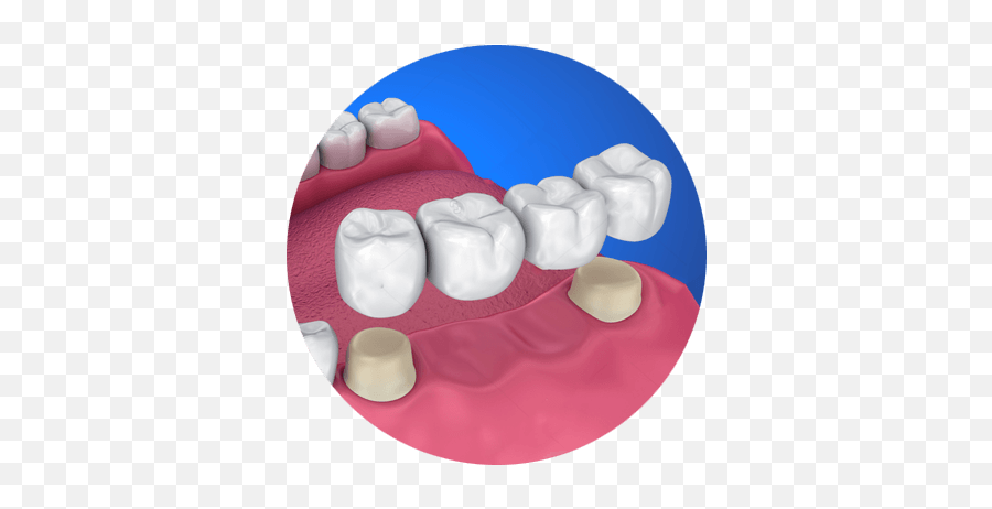 Restoration Dr Matthew S Ginsburg Dmd - Dental Bridge Crown Emoji,Gap Tooth Emoticon