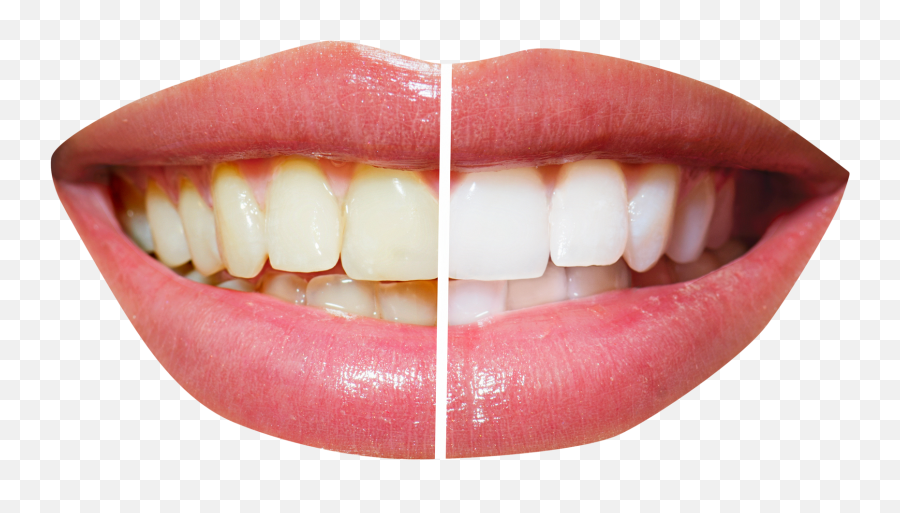 October 2016 - Teeth Whitening Png Emoji,Emojis Imagenes Dientes