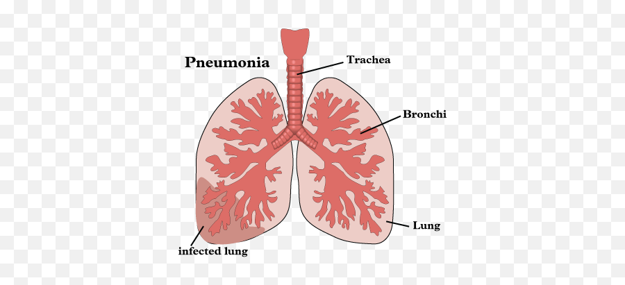 Ineffective Airway Clearance Care Plan - Aerobic And Anaerobic Respiration Emoji,Gastric Cancer Nursing Diagnosis Emotion