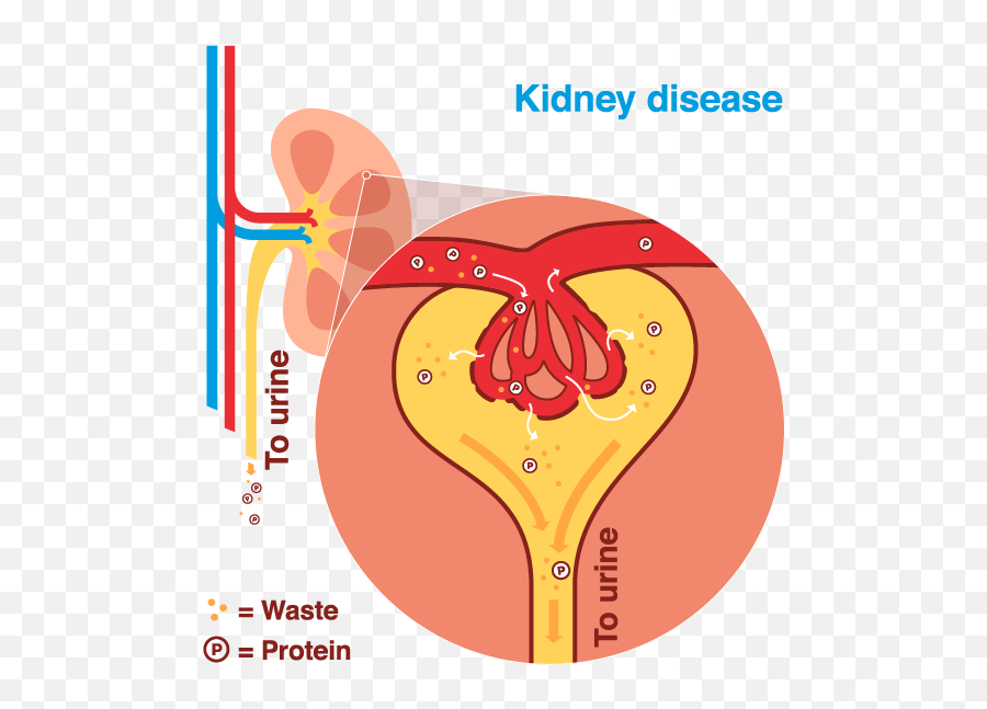 Diabetic Nephropathy Disease - Diabetic Kidney Disease Emoji,Position, Location, Action, Condition, And Emotion.