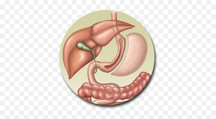 Sleeve Gastrectomy Procedure In Reno U2013 Western Bariatric - Vertical Sleeve Gastrectomy Emoji,Emotions On Sleeve