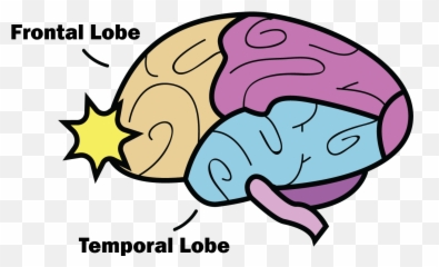 Clipart Brain Concussion - Frontal And Temporal Lobes Emoji,Temporal Lob Emotion