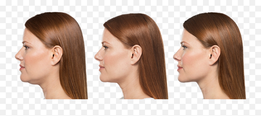 Botox Injections - Kybella Before And After Emoji,Botox On Emotion