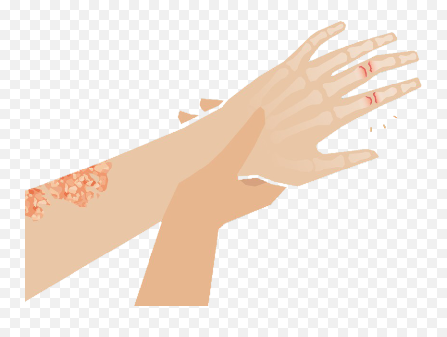 Psoriatic Arthritis - Clinlife Emoji,Pointed Hand Emoji