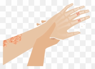 Psoriatic Arthritis - Clinlife Emoji,Pointed Hand Emoji