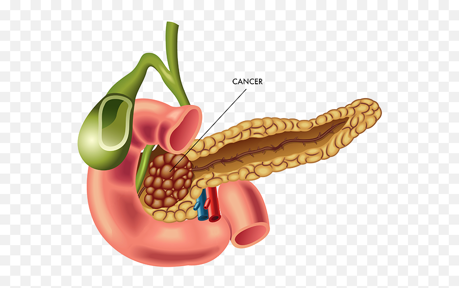 Kidney Pancreas Transplant Emoji,Emotions Spleen Pancreas