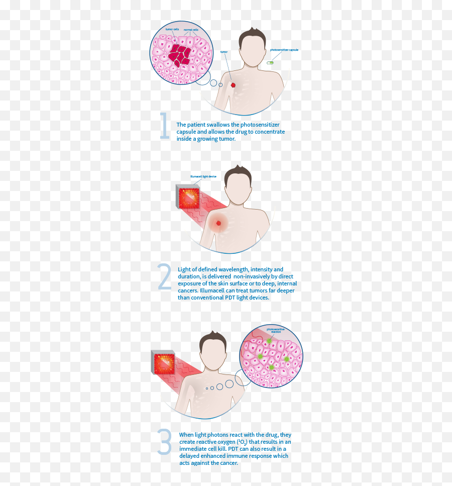 Photodynamic Tumor Therapy - For Adult Emoji,Tiida 2008 Emotion