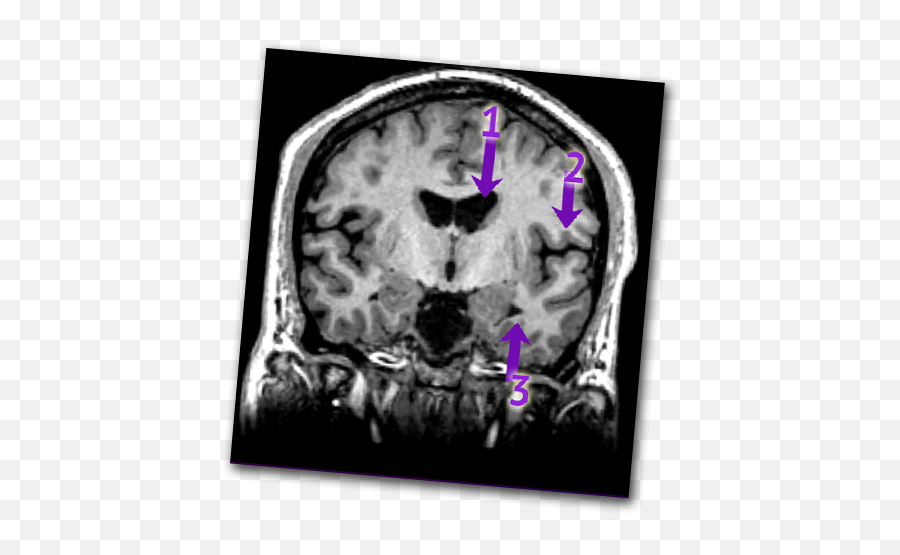 Schizophrenia And Mri Imaging - Schizophrenia Mri Emoji,Schizophrenia & Emotions